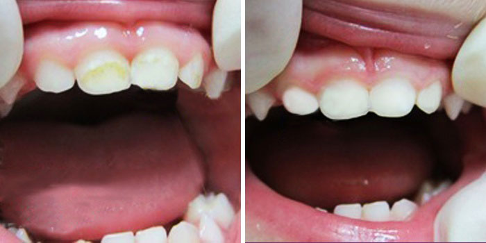 Фторирование молочных зубов: особенности процедуры и её преимущества