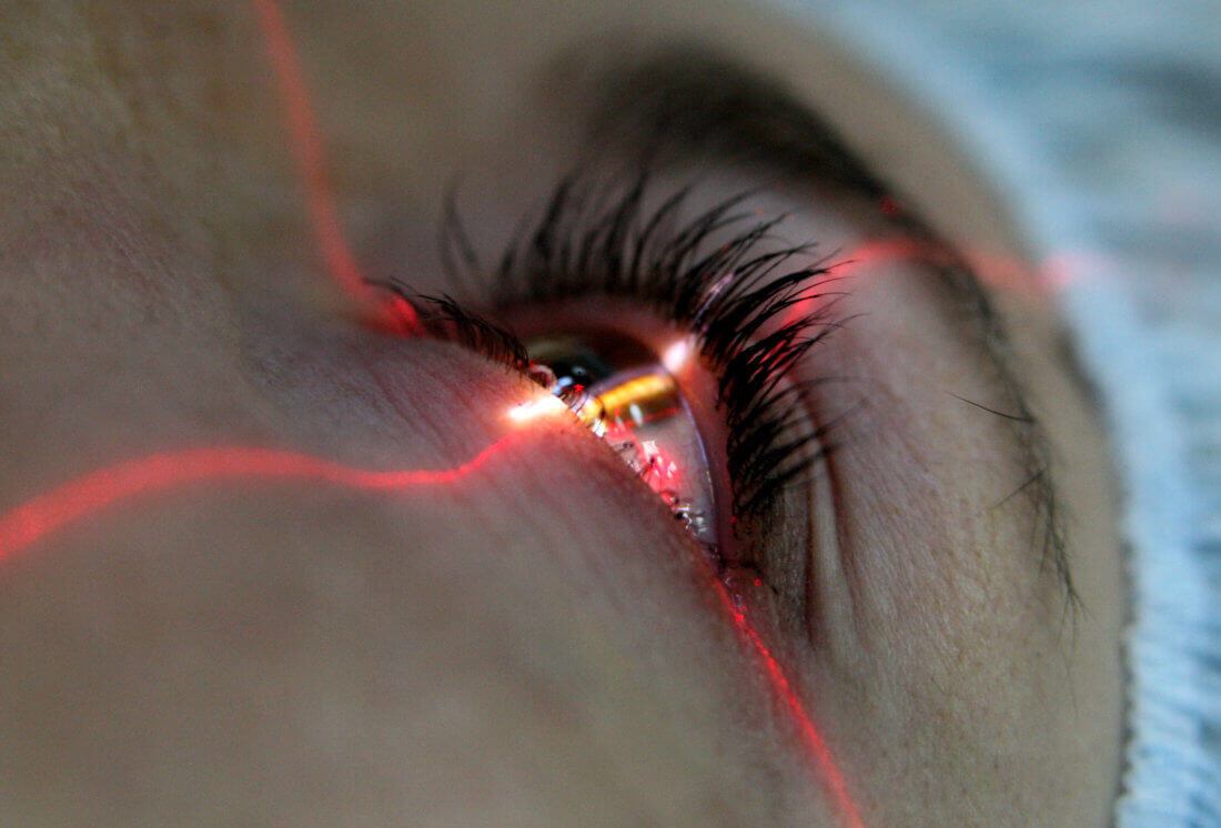 Коррекция зрения при помощи лазера — этапы проведения операции