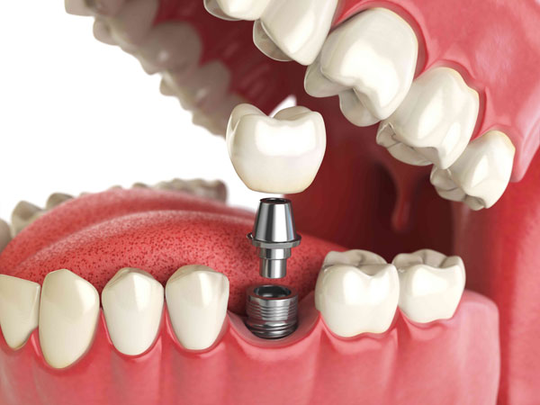 Стоматологическая клиника Дентал Бутик — Лечение пульпита зубов