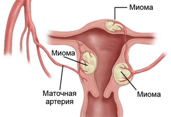 Методика диагностики и обследования миомы матки