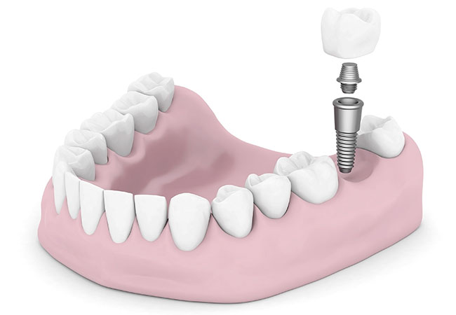 Имплантация зубов по современным технологиям