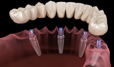 Полный Ряд Зубов за Один Раз: Плюсы и Минусы All-On-4 Имплантации