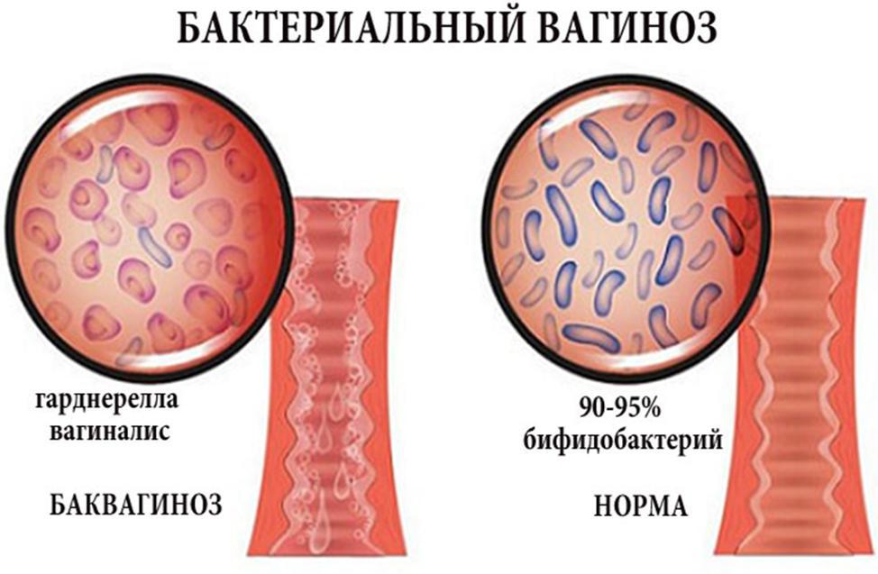 Лечение бактериального вагиноза