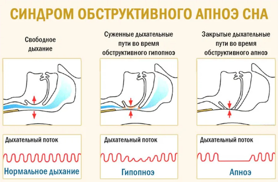 Дыхательная гимнастика, точечный массаж и упражнения от храпа для мужчин и женщин в домашних условиях