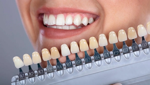 Виниры и вкладки Emax: Превосходство керамической эстетики в стоматологии